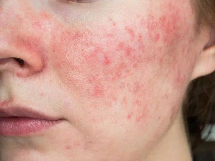 3 causes of sensitive skin & a science-backed recovery routine from Nzheal 1 3 causes of sensitive skin & a science-backed recovery routine from Nzheal 8